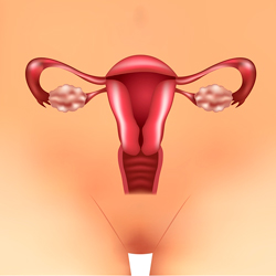 polycystic ovarian syndrome